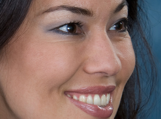 Botox and Juvederm Skin Treatments Treated Botox and Juvederm Skin Treatments Treated