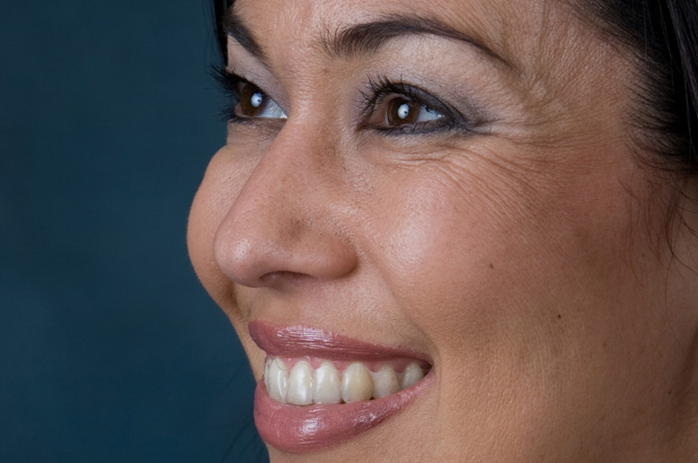 Botox and Juvederm Skin Treatments Untreated Botox and Juvederm Skin Treatments Untreated