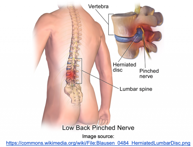 Best Treatment For Neck Pain Tingling, Cervical Disc Herniation